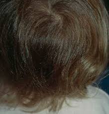 These disrupt the hair while it is in the anagen phase. Loose Anagen Syndrome Pluckable Hair Loose Hair Syndrome Loose Anagen Hair Syndrome Syndrome Of Loosely Attached Hair In Childhood Dermatology Advisor