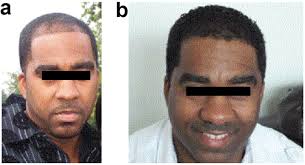 One trend that affects blacks more than others is the use … African American Hair Loss What Can Be Done
