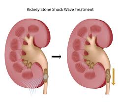 Lithotripsy Treatment For Urinary Stones Fv Hospital