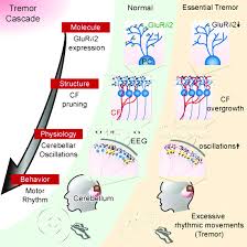 Image result for Essential Tremor