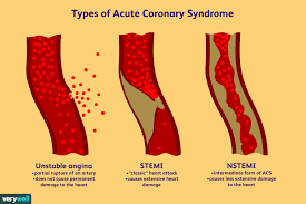 Myocardial infarction (heart attack) — stemi vs. Nstemi Non St Segment Myocardial Infarction Explained