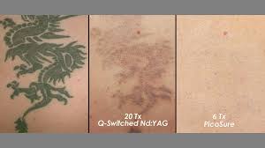 Check out a blog being kept by one of our current patients that details her. Naseljenci Paket Ali Paket Vzvod Laser Tattoo Removal Melbourne Jhouserconstruction Com