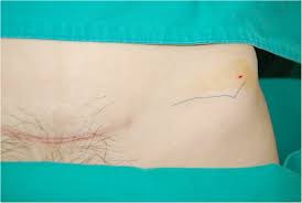 The extraction of sutures from granuloma sinuses has been accomplished traditionally by fishing for it with a crochet hook. Spontaneous Complete Migration Of Suture Material After Subcuticular Continuous Suture In Cesarean Section A Case Report Bmc Surgery Full Text