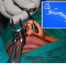 Infection can develop deep in the mucoperichondrial layer; Pdf Nasal Septal Clips An Alternative To Nasal Packing After Septal Surgery