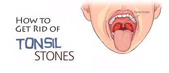 Good news here is some effective ways fo. 3 Different Ways To Treat Tonsil Stones At Home Women Daily Magazine