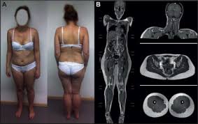 Two forms of the disease with different. Abnormal Proliferation And Spontaneous Differentiation Of Myoblasts From A Symptomatic Female Carrier Of X Linked Emery Dreifuss Muscular Dystrophy Sciencedirect