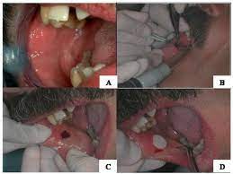 What is oral tissue biopsy surgical procedure? Oral Mucosa Biopsy A The Specimens Were Taken From The Mouth At The Download Scientific Diagram