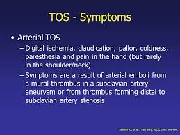An Interesting Case Of Thoracic Outlet Syndrome Ppt Video Online Download