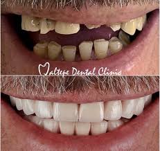 Check spelling or type a new query. Dental Implants And Veneers From Turkey Our Prices