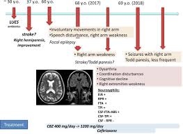 Image result for Neurosyphilis