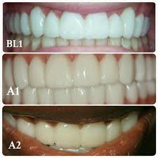 Image Result For Bl1 Dental Shade Stained Teeth Celebrity Smiles How Are You Feeling