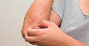 Ada tiga kelompok otot di paha yang dapat menimbulkan rasa nyeri: Kenali Penyakit Kurap Obat Cara Mengobati Dan Penyebabnya Diadona Id