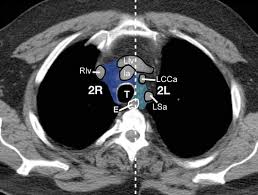 Left supraclavicular lymph node my story. International Association For The Study Of Lung Cancer Iaslc Lymph Node Map Radiologic Review With Ct Illustration Radiographics