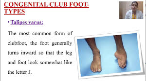 Both feet are affected in about half of. Congenital Club Foot In Child Kerala Nurses Hub Youtube