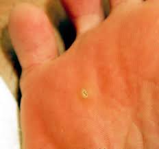 Warzen Lealea Naturliche Creme Zur Warzen Leberfleck Und Muttermalentfernung