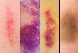 Strep throat, which is a bacterial infection that leads to a sore throat. Pictures Of Bruises What The Black And Blue Is Telling You