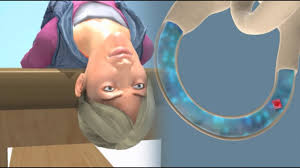 Deep Head Hanging Maneuver To Treat Bppv Vertigo