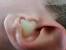 Painful Pimple In Ear Canal