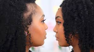 Once the hormone levels get back to a normal rate the dramatic shedding episode will cease. Pin On Hair