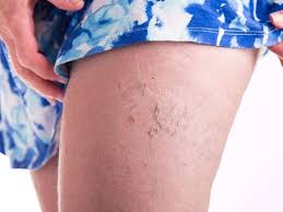 Varicose veins stock photography by rob3000 25 / 349 varicose veins stock images by lighthunter 15 / 180 varicose veins stock photography by zlikovec 7 / 325 varicose veins stock images by hriana 8 / 78 varicose vein stock photo by megija 29 / 905 varicose veins pictures by jjvallee 2 / 354 varicose veins stock image by zlikovec 3 / 86 painful. 8 Advantages Of Laser Treatment For Varicose Veins Laptrinhx