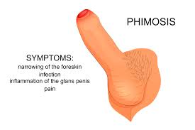 Image result for Phimosis