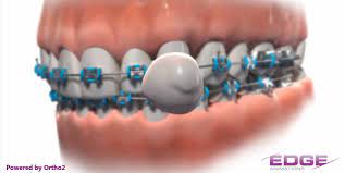 Check spelling or type a new query. How Do I Use That Braces Wax Salem Pediatric Dental