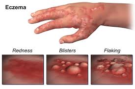 Image result for Atopic eczema atopic dermatitis