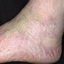 It isn't usually serious, but it can be irritating. Home Remedy For Dry Itchy Skin You Can Heal Your Dry Itchy Skin At Home Dry Skin Home Remedies Home Health Remedies Dry Skin Treatment