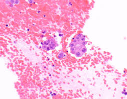 Malignant mesothelioma is a cancer caused by exposure to asbestos, a toxic mineral the majority of cases are pleural mesothelioma, which forms in the lining of the chest cavity, known as the pleura. Multicystic Benign Mesothelioma Pathology Outlines Pathology Outlines Diffuse Malignant Mesothelioma Maybe You Would Like To Learn More About One Of These