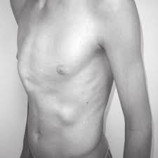 Pectus excavatum, also known as funnel chest, is a condition where the breastbone of the sufferer grows inward. Pdf Pectus Carinatum