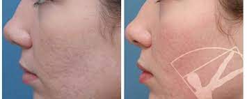 Quelle recette utiliser pour atteindre ses objectifs il faut savoir qu'après le peeling, vous risquez d'avoir la peau rouge voire quelques petits boutons. Peeling Chimique Du Visage Tout Sur Une Technique Non Chirurgicale