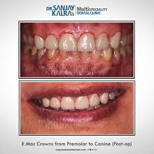 We Used A Wax Mockup To Show The Patient What The Final Result Would Look Like After The Preparation Of T Esthetic Dentistry Affordable Dental Dental Check Up