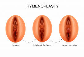 Hymenoplasty Hymen Reconstruction Procedure Reasons Recovery