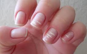 Cependant, si c'est à cause de en matière d'alimentation, les taches blanches ne sont pas liées à ce que nous mangeons, mais vous pouvez certainement obtenir des ongles plus forts. Pourquoi Des Marques Blanches Apparaissent Sur Les Ongles Ameliore Ta Sante