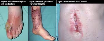 Aureus is worldwide, and therefore many people have these bacteria in their bodies, meaning they are. Skin And Soft Tissue Infection Focus On Meticilllin Resistant S Aureus The Pharmaceutical Journal