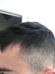 Is The Left Front Side Of My Hair Thinning Hairlosstalk Forums