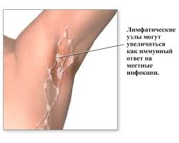 Shishki V Podmyshechnyh Vpadinah U Muzhchin Shishka Pod Myshkoj Bolit Chto Eto Mozhet Byt I K Kakomu Vrachu Obratitsya