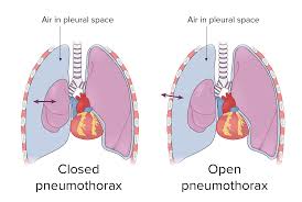 Image result for Pneumothorax