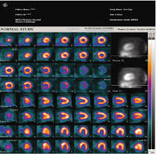 This is a short introduction to the message passing interface (mpi) designed to convey the there exists a version of this tutorial for c programers called introduction the the message passing. A Normal Spect Mpi Study Performed At 111 333 Mbq 3 9mci Download Scientific Diagram