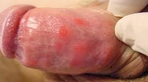 See more of ciri ciri sipilis pada pria on facebook. Meridiasupremecourtdecisionhvd Pengobatan Herbal Sipilis Pada Lelaki