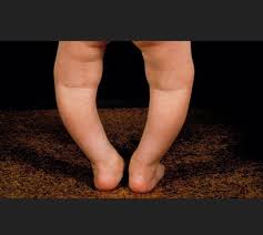 Image result for Rickets