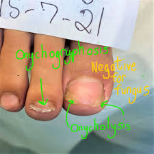 Image result for Onycholysis feet
