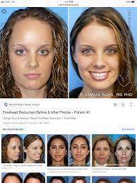 Pin By Sierra Hunt On Cosmetic Forehead Reduction Forehead Reduction Surgery Plastic Surgery