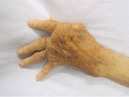 Because it bit my finger so. Effects Of Ageing On Hand Function Physiopedia