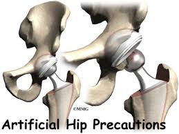 Maybe you would like to learn more about one of these? Artificial Hip Dislocation Precautions Eorthopod Com