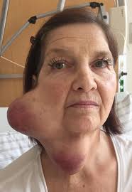 Richter-Transformation: Zelluläre Therapien