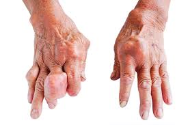 Image result for gout