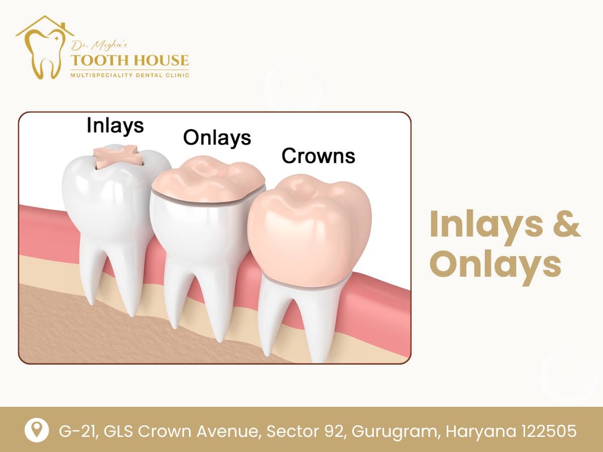 Inlays & Onlays product image