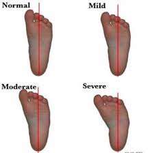 Image result for Out-toeing