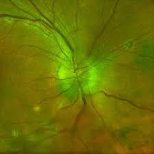 Image result for Optic Neuritis